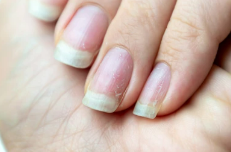 What causes brittle nails?